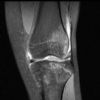 MRI Knee - PD - Fat Saturated - Coro - Bone Marrow Oedema Lateral aspect of the Tibial plateau