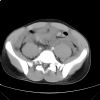 Lateral compression pelvic fracture. CT. Courtesy of Dushan Atkinson