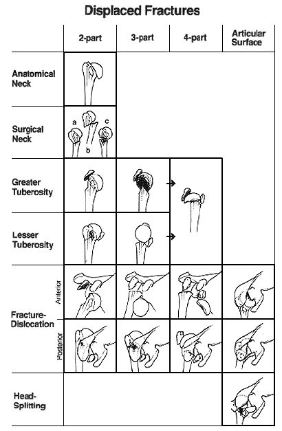 Neer Classification