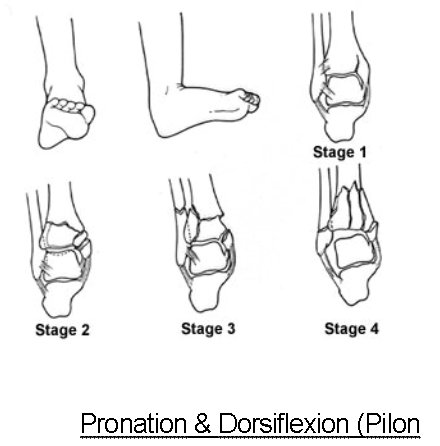 Medial+malleolus